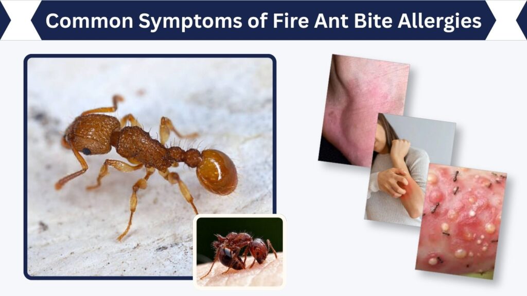 Common Symptoms of Fire Ant Bite Allergies