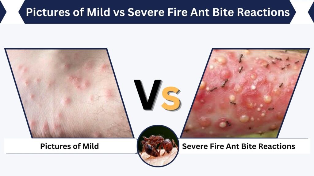 Pictures of Mild vs Severe Fire Ant Bite Reactions