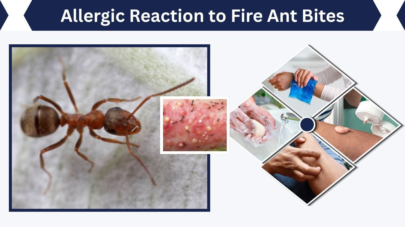 Allergic Reaction to Fire Ant Bites: Signs and Treatment