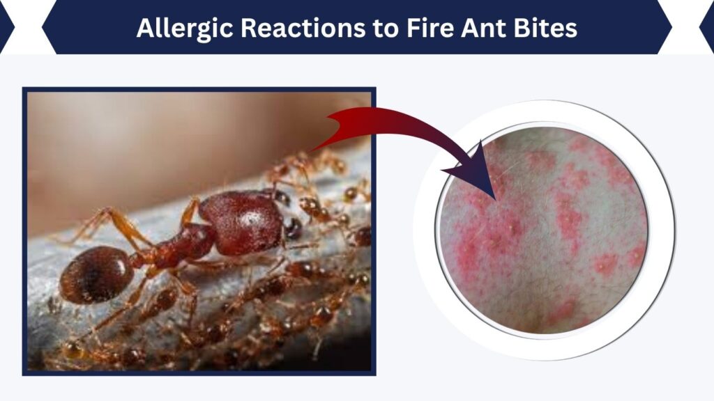 Allergic Reactions to Fire Ant Bites
