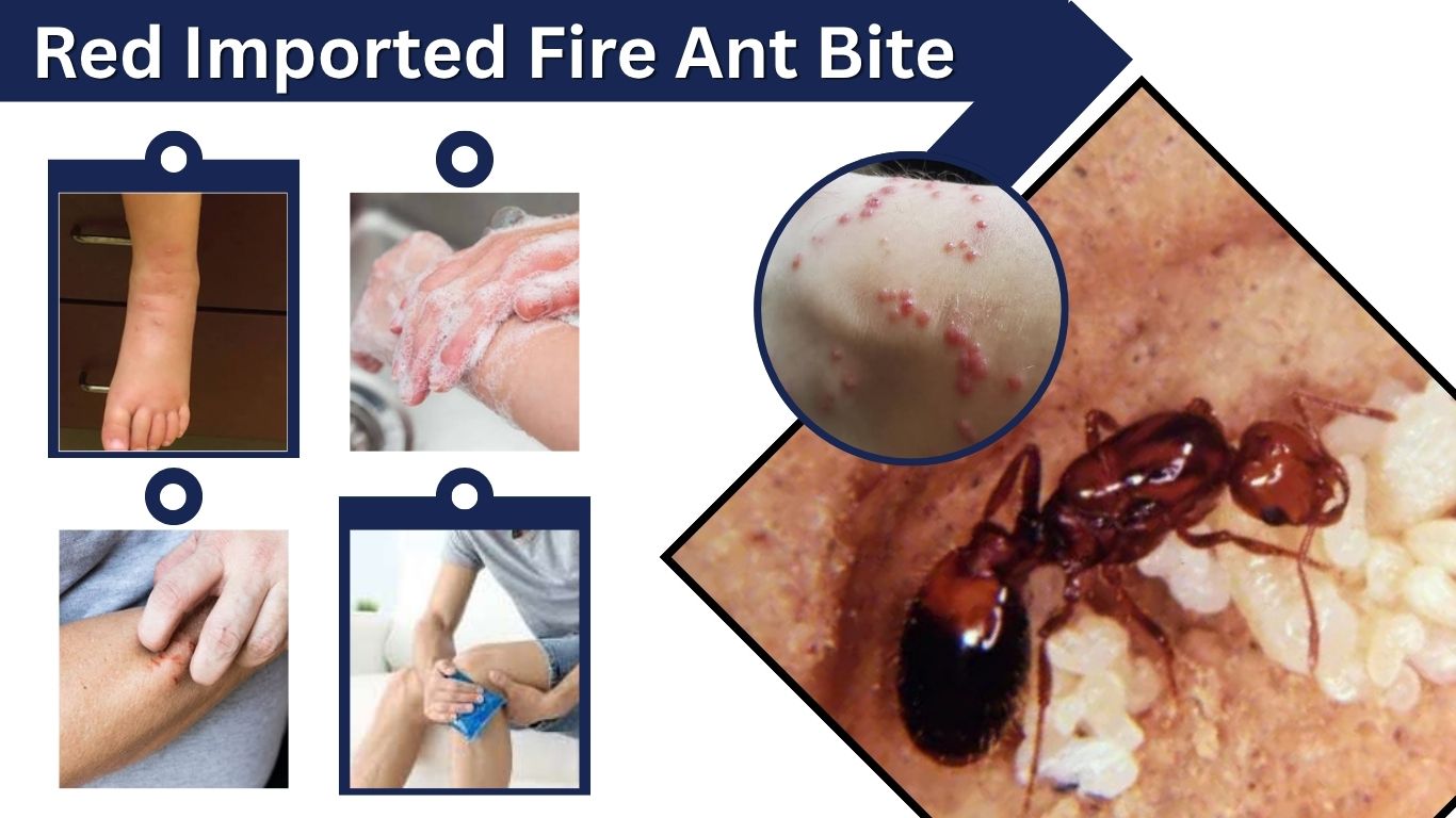 Red Imported Fire Ant Bite: Symptoms and Treatment